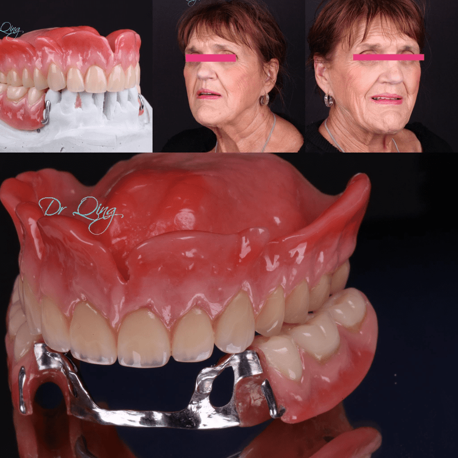 Just regular denture still shines