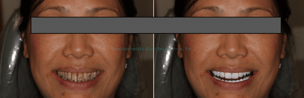 From smile design to execution and realization—Digital way