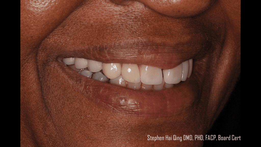 Esthetic Removable Partial Denture