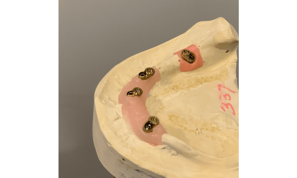Customized locator abutment improve the precision of snap-on dentures