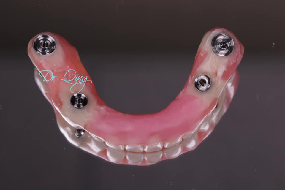 Humanbeing’s third dentition in one day