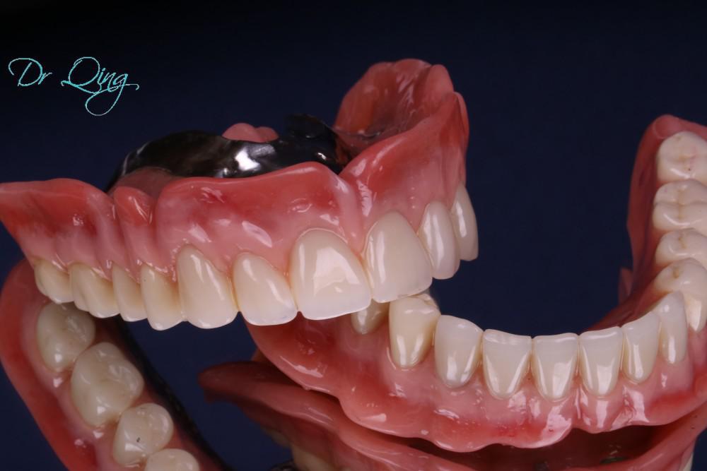 I can eat the corn on the cob now—Implant over denture