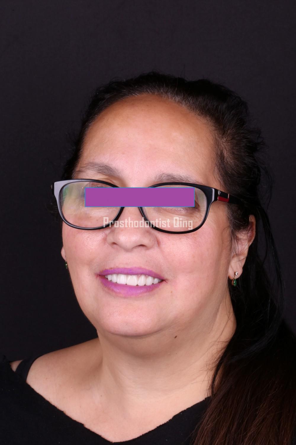 One-day smile using cost-effective immediate temporary denture