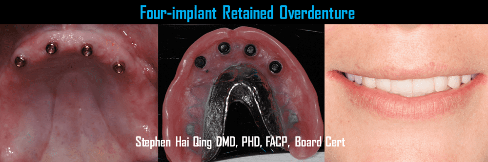 Implant Supported Overdenture