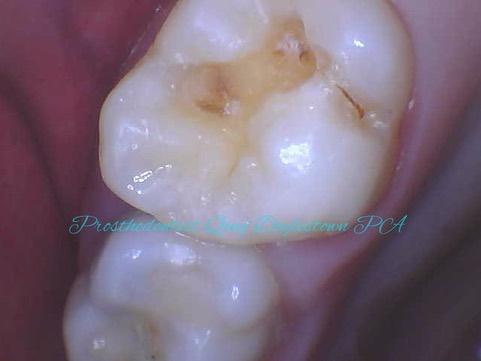 Diagnosis of tooth decay needs attention to details