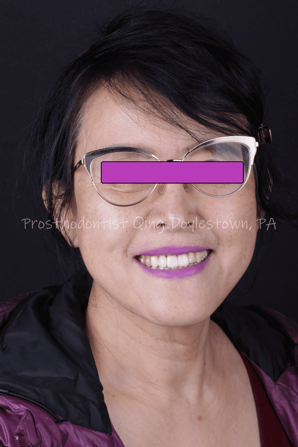 Smile make over within one week for a physician from Hawaii
