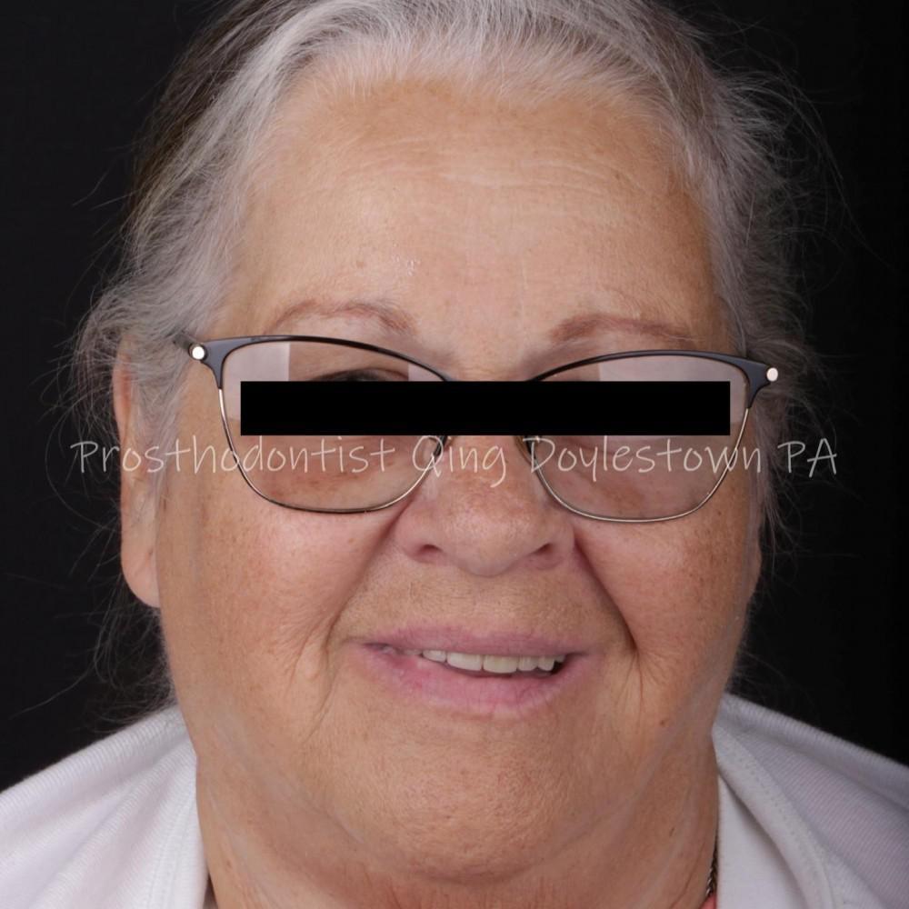 Long-term provisional crowns for terminal stage cancer patients
