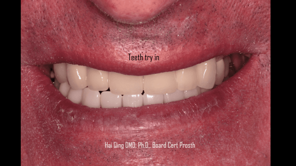 Dental Bridge: Pros, Cons and Maintenance
