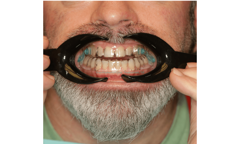 Dental treatment of obstructive sleep apnea ( Anti-snoring device)