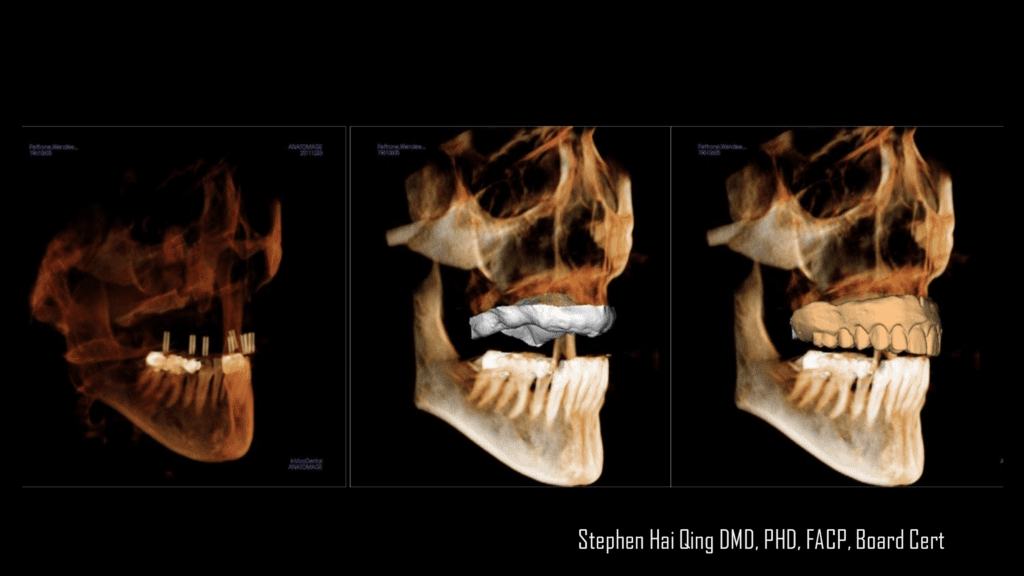 Implant-supported crown and bridge prosthesis—Pros and Cons, and Maintenance instruction