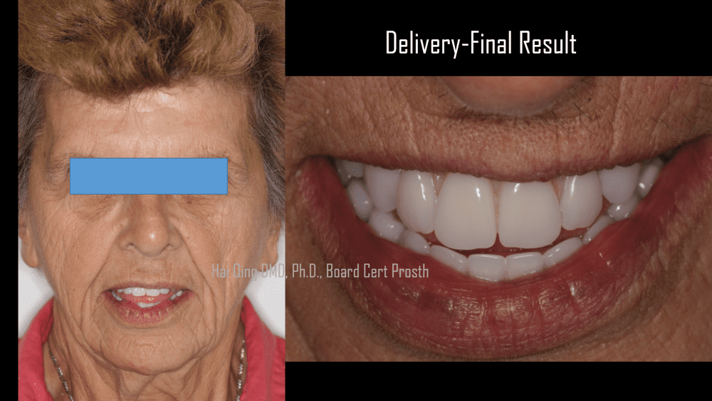 Implant Supported Fixed Denture ( other names as All-on-four or hybrid)