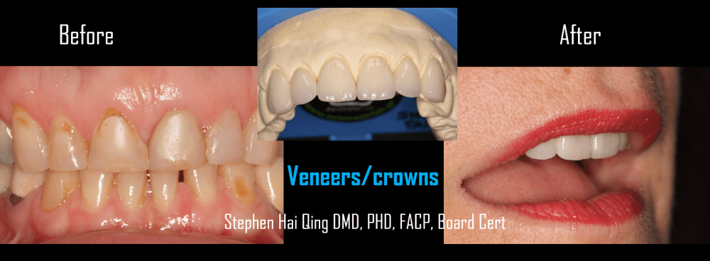 Cosmetic Ceramic Veneers- Pros, Cons and Maintenance