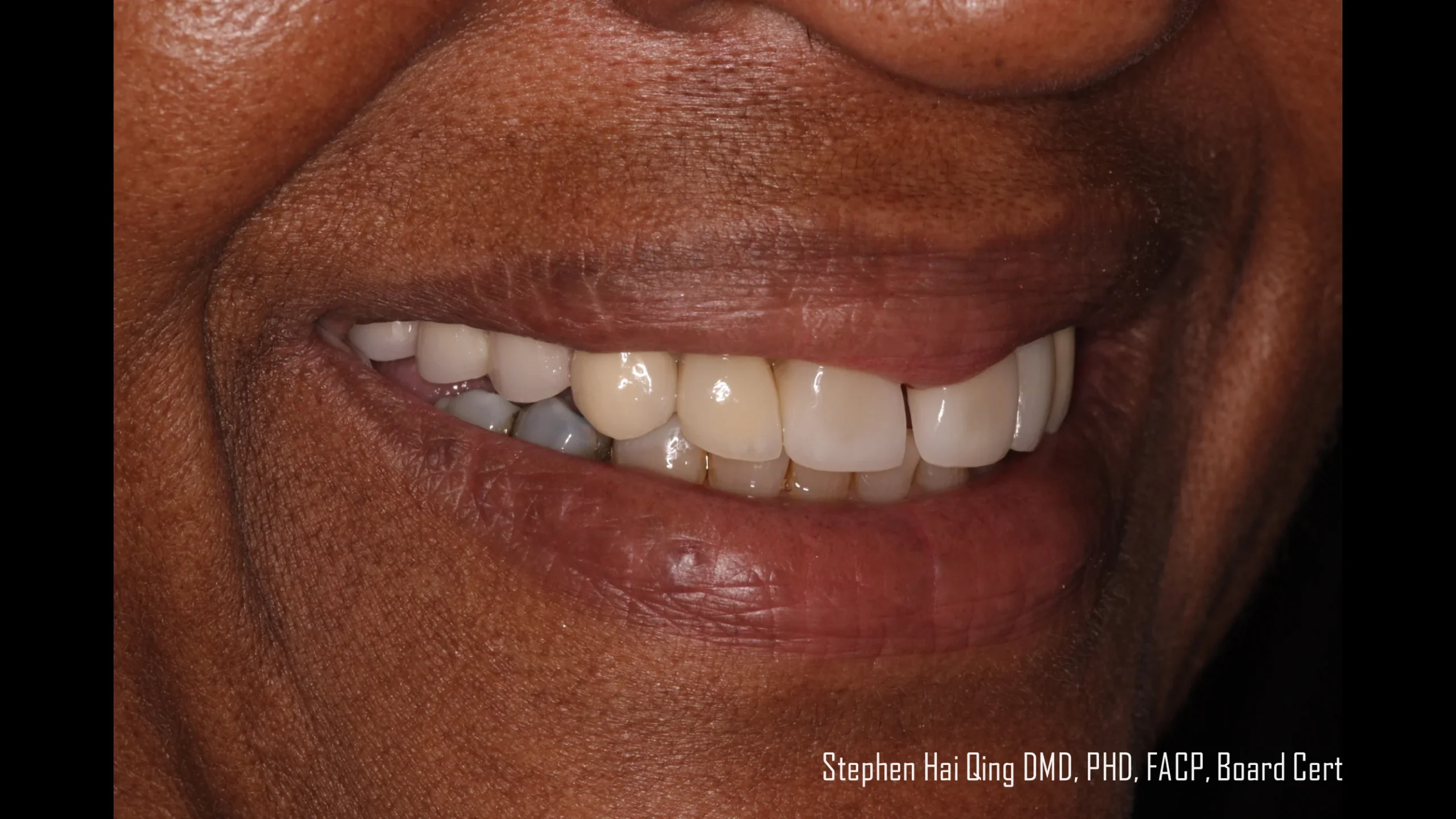 Esthetic Removable Partial Denture patient