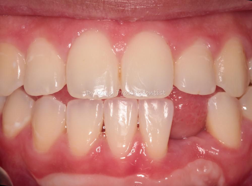 Resin-bonded Fixed Partial Denture patient