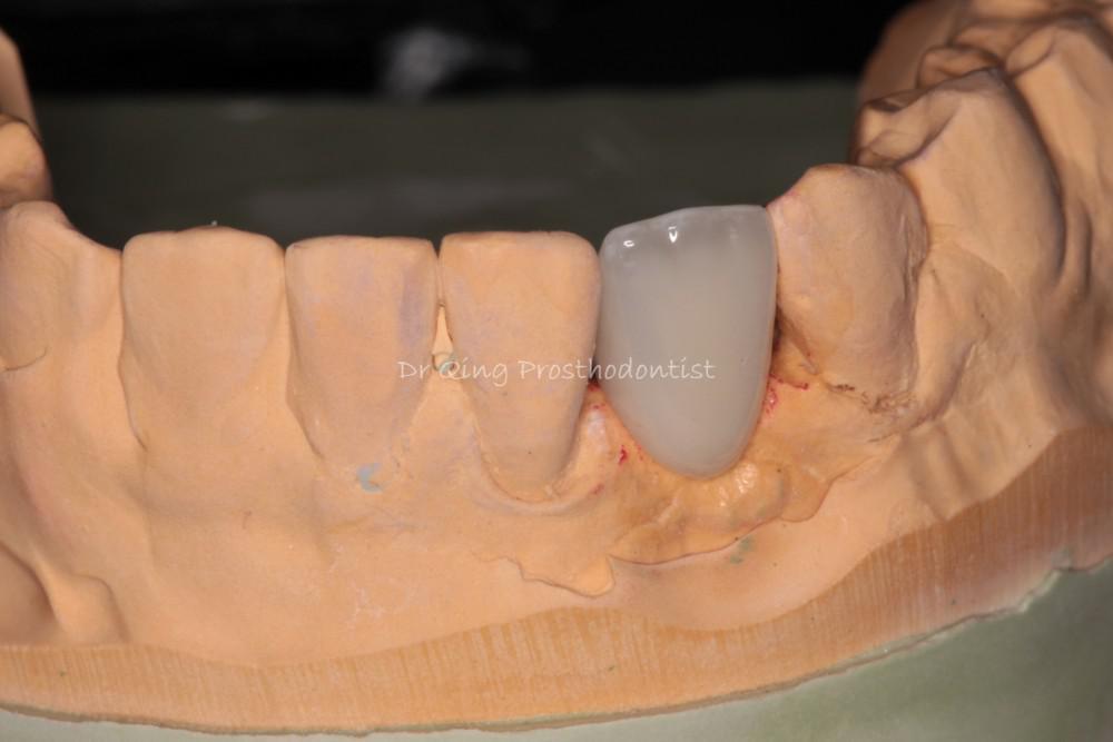 Resin-bonded Fixed Partial Denture patient