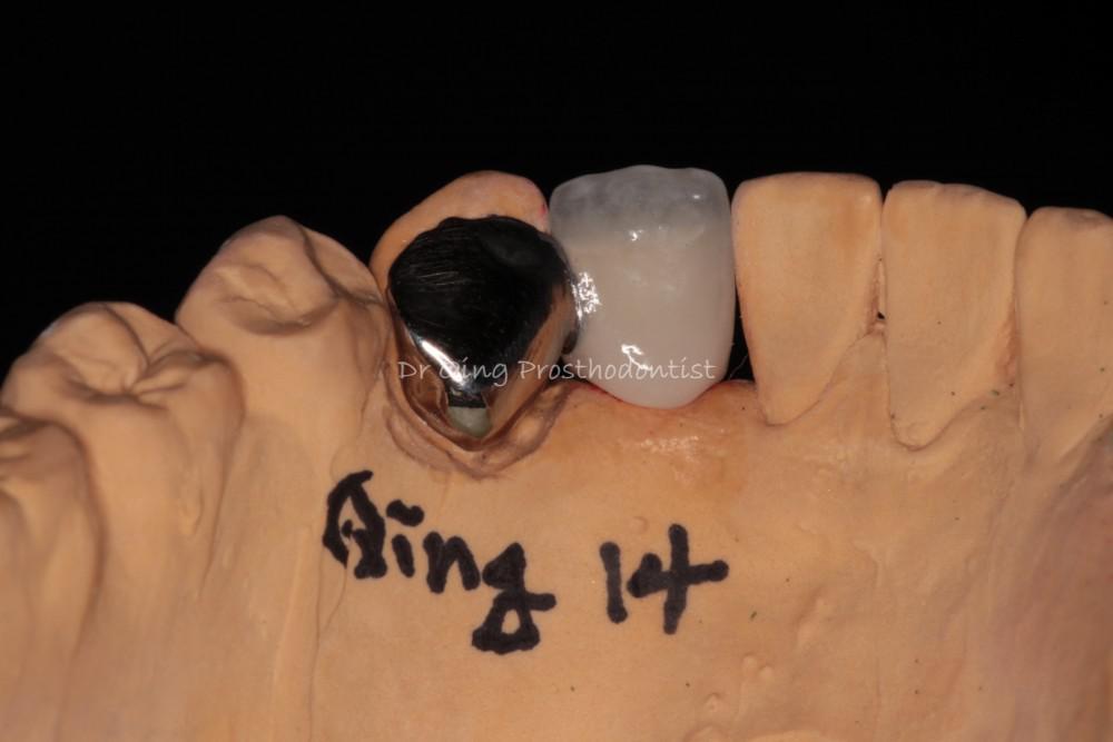 Resin-bonded Fixed Partial Denture patient