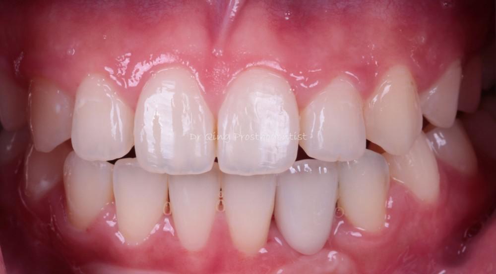 Resin-bonded Fixed Partial Denture patient