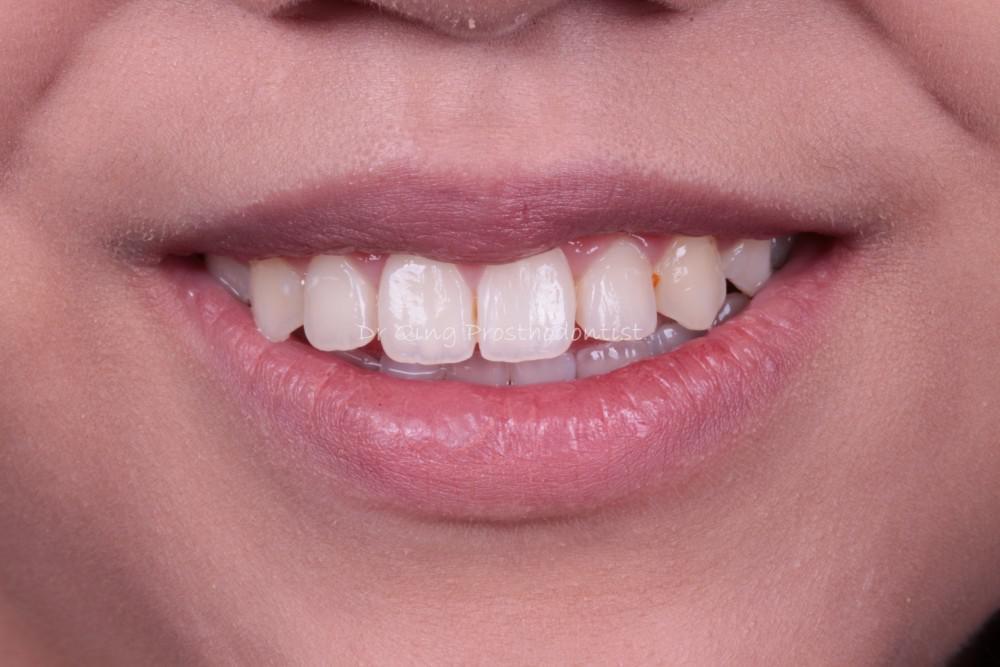 Resin-bonded Fixed Partial Denture patient